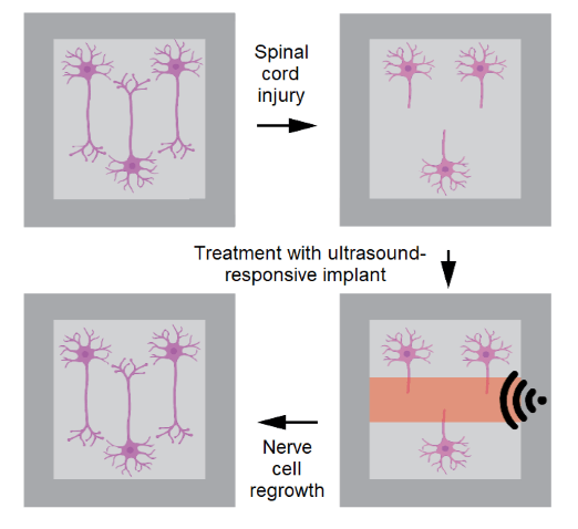 Development of an ultrasound-responsive implant to treat spinal cord injury